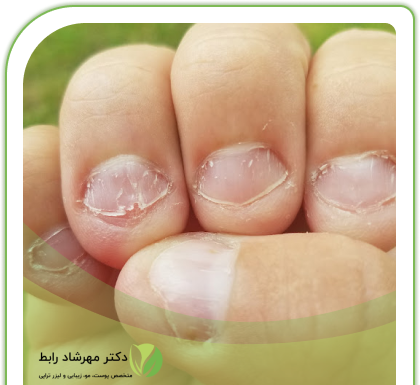 عکس قارچ گرفتن ناخن
