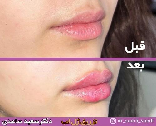 عکس ژل لب اردکی