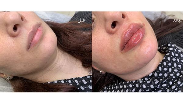عکس مدل لب اردکی