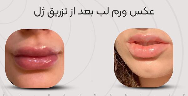 عکس مدل لب اردکی