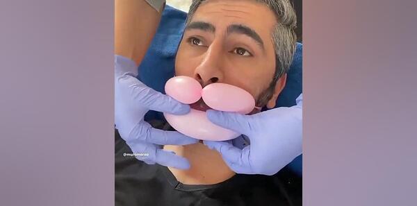عکس لب پروتز خنده دار