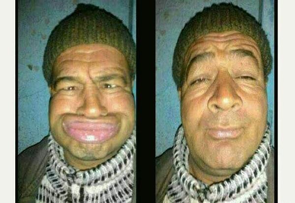 عکس لب پروتز خنده دار