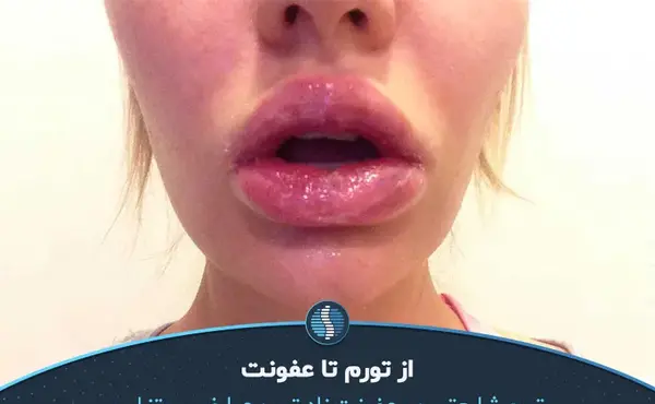 عکس لب پروتز بزرگ
