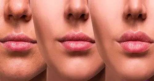 عکس لب پروتز بزرگ