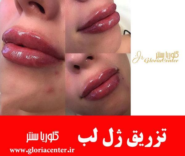 عکس لب پروتز بزرگ