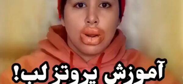 عکس لب پروتز کرده