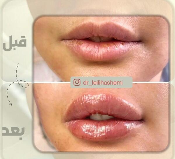 عکس لب پروتز کرده