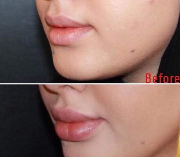 عکس لب پروتز کرده