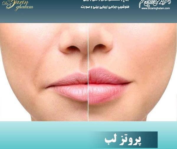 عکس لب پروتز کرده