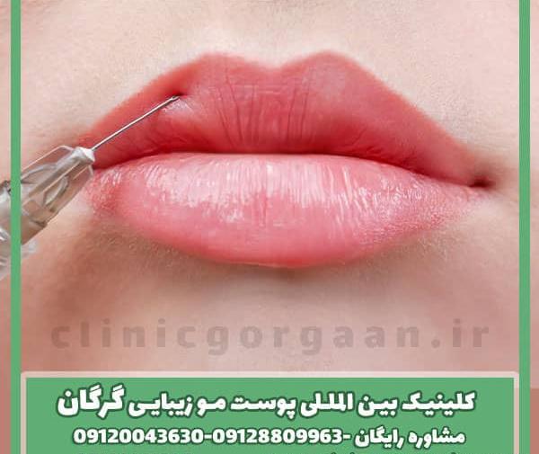 عکس لب پروتز طبیعی
