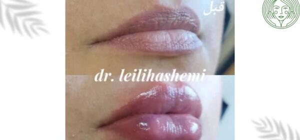عکس لب پروتز طبیعی