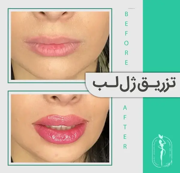 عکس لب پروتز طبیعی