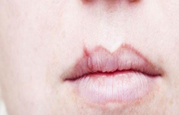 عکس های لب جوش