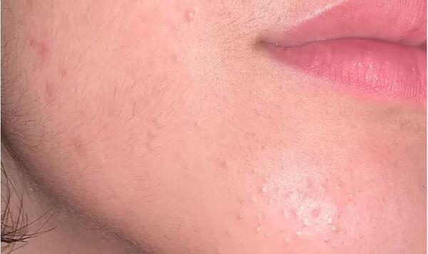 عکس های لب جوش