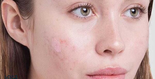 عکس های لب جوش