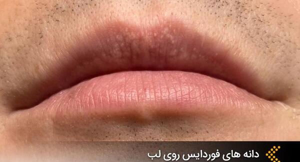 عکس های لب جوش