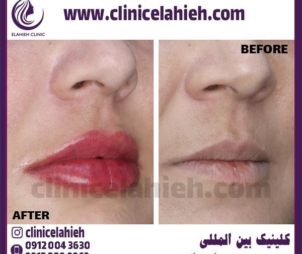 عکس حجم دهنده لب دائمی