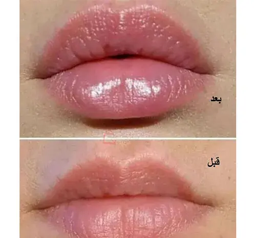 عکس حجم دهنده لب گابرینی
