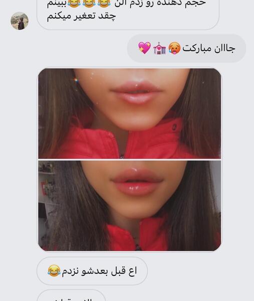 عکس حجم دهنده لب گابرینی