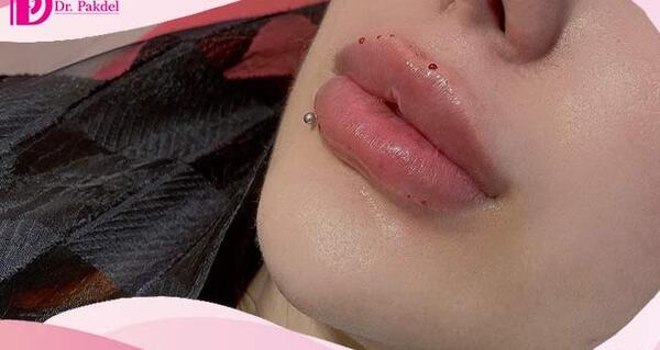 عکس لب ژل زده بزرگ