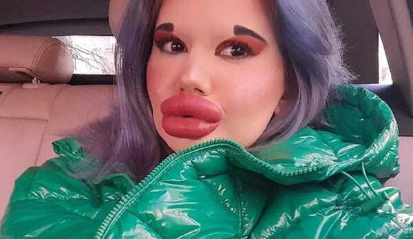 عکس لب ژل زده بزرگ