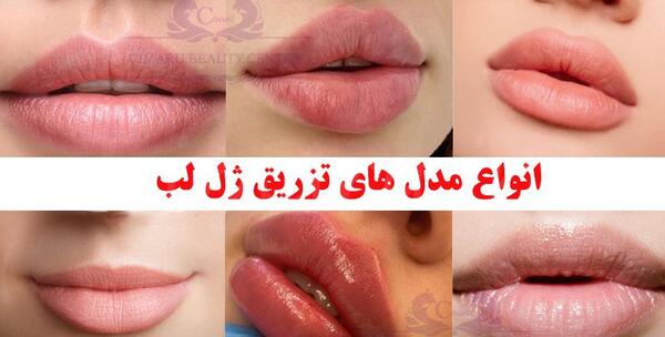 عکس لب ژل زده طبیعی