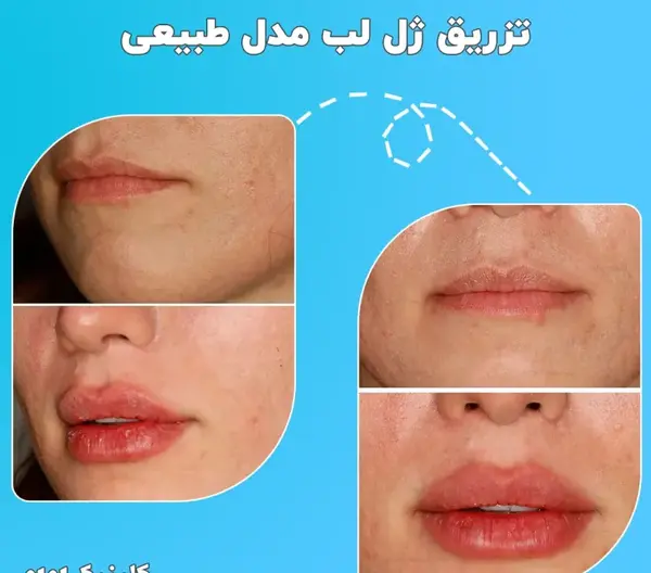 عکس لب ژل زده طبیعی