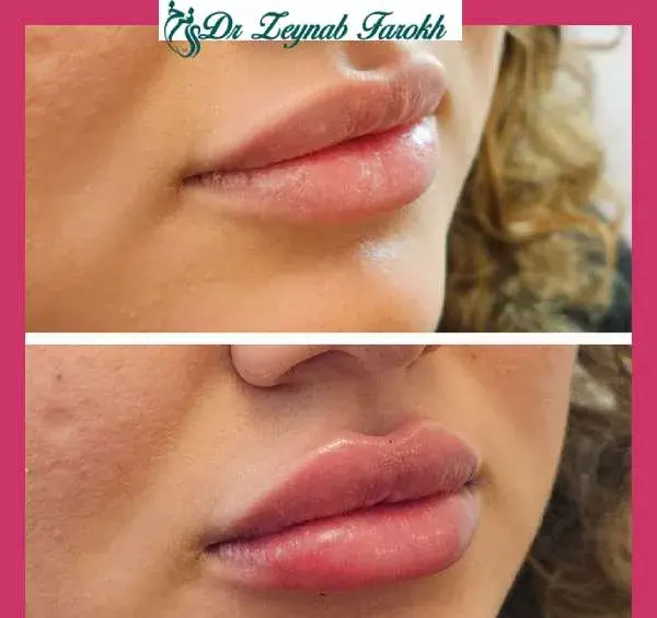 عکس لب ژل زده طبیعی