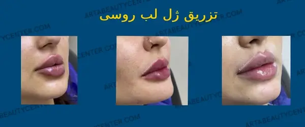 عکس لب ژل زده طبیعی