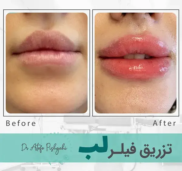 عکس لب ژل زده طبیعی