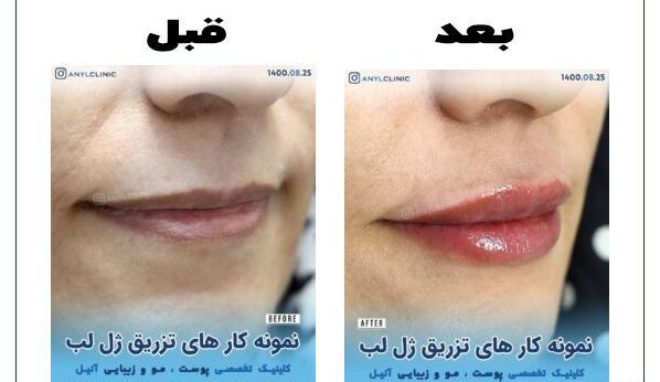 عکس لب ژل زده روسی
