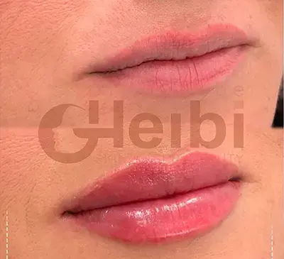 عکس لب ژل زده روسی