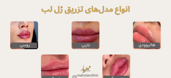 عکس لب ژل زده روسی