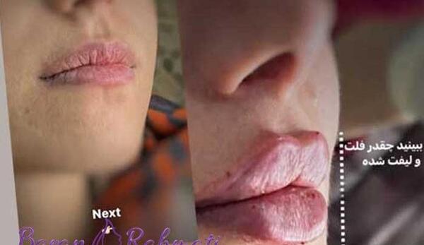 عکس لب ژل زده روسی