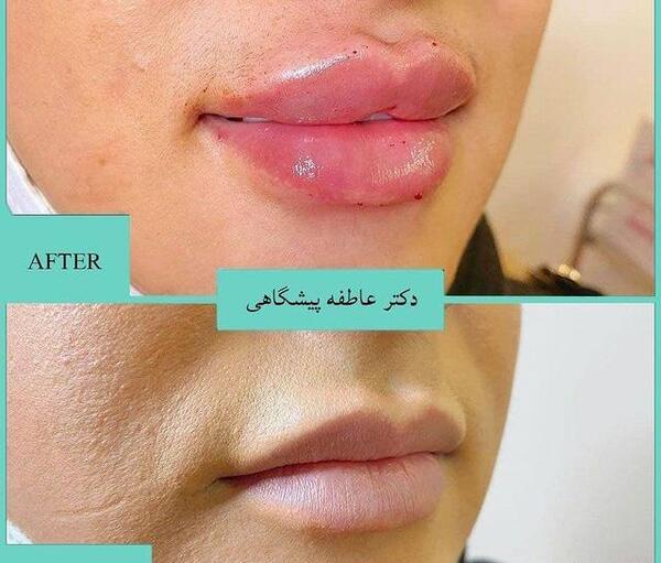 عکس لب ژل زده روسی