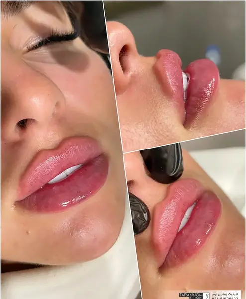 عکس لب ژل زده روسی