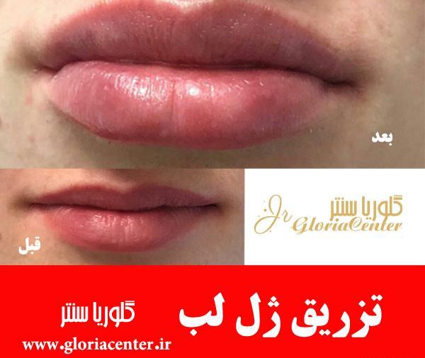 عکس لب ژل زده زیبا