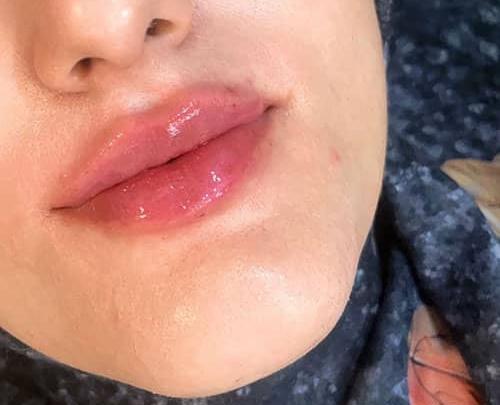 عکس لب ژل زده زیبا
