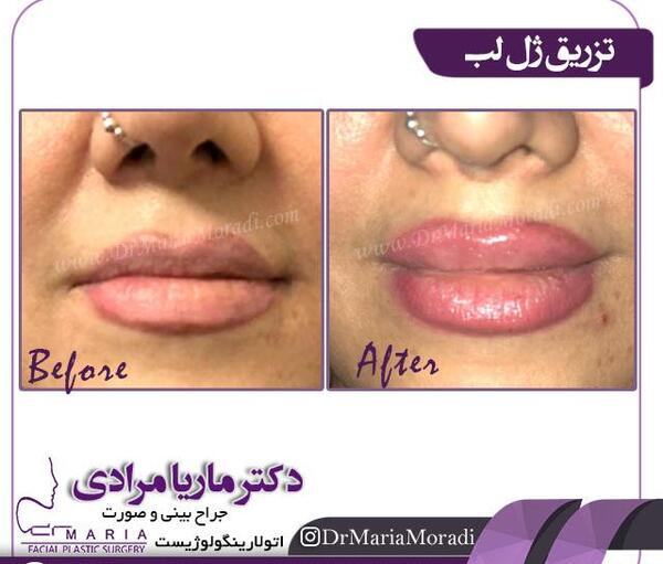 عکس لب ژل زده زیبا
