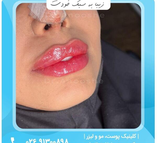 عکس لب ژل زده زیبا