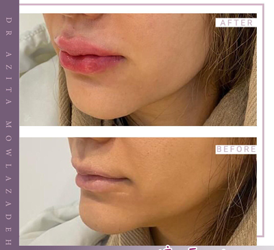 عکس تزریق ژل لب نیم سی سی