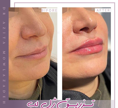 عکس تزریق ژل لب نیم سی سی