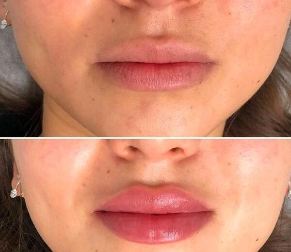 عکس تزریق ژل لب نیم سی سی