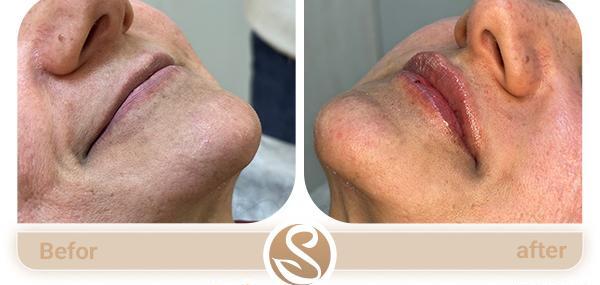 عکس تزریق ژل لب نیم سی سی