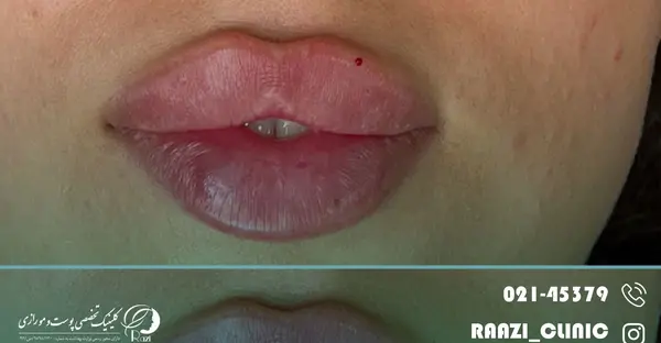 عکس تزریق ژل لب نیم سی سی