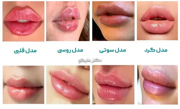 عکس تزریق ژل لب نیم سی سی