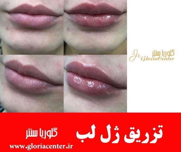 عکس تزریق ژل لب نیم سی سی