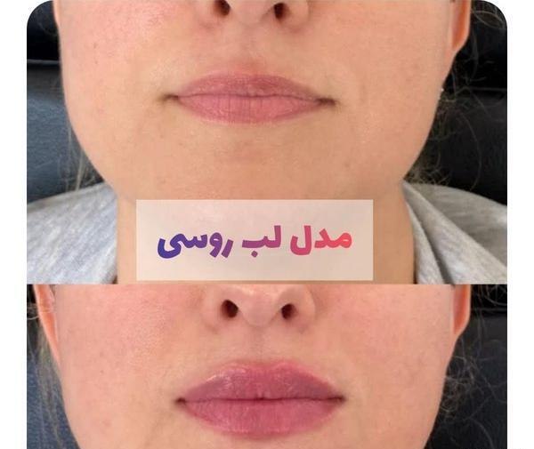 عکس تزریق ژل لب نیم سی سی