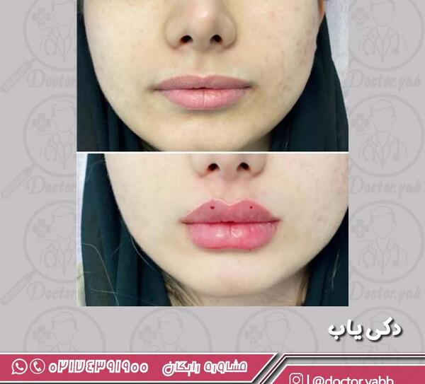 عکس تزریق ژل لب نیم سی سی