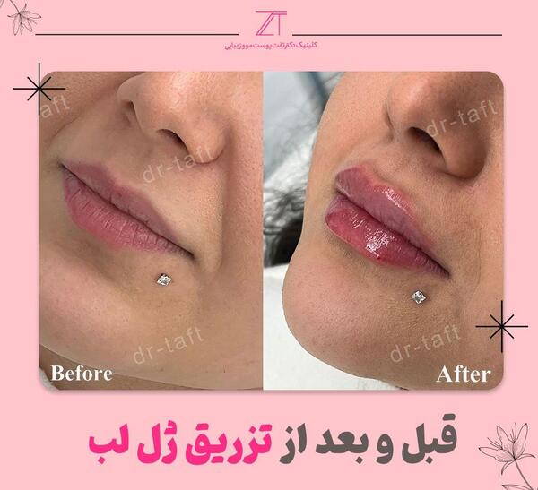 عکس تزریق ژل لب نیم سی سی